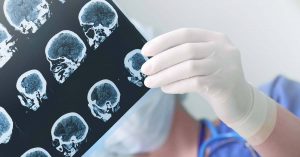 Parálisis cerebral como secuela de una negligencia