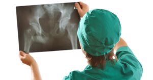 Negligencias Médicas en Prótesis de Cadera